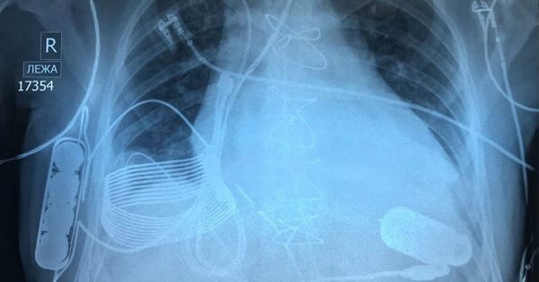 New Bionic Heart Charges Wirelessly Inside Patient’s Chest